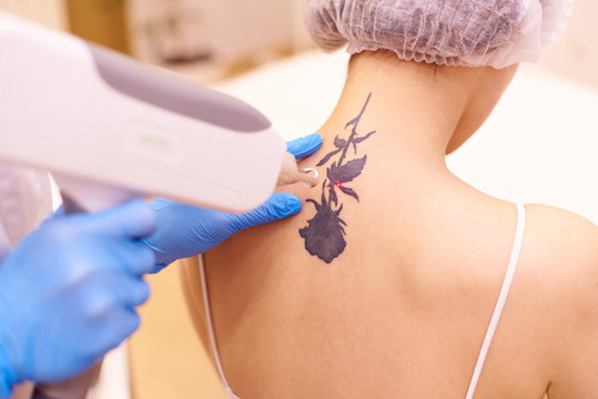 Tattoo Removal.jpg